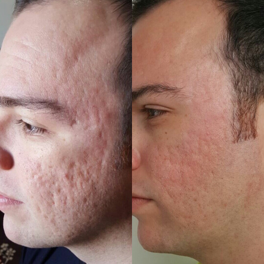 Microagulhamento Antes E Depois Para Cicatriz De Acne 6603